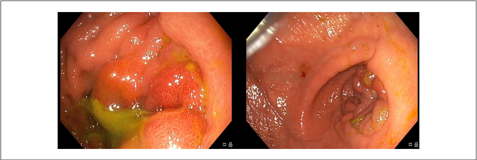 Endoscopic images of obstructed efferent loop