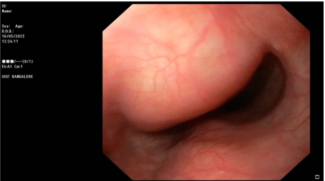 Gastroduodenoscopy showing a smooth submucosal bulge in the mid-esophagus