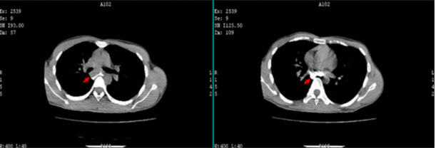 Contrast-enhanced CT chest showing a smooth submucosal soft tissue lesion in the esophagus