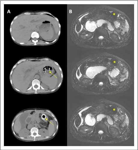 Serial CT and MRI images showing biliary dilatation and a dilated bowel loop adjacent to SEMS