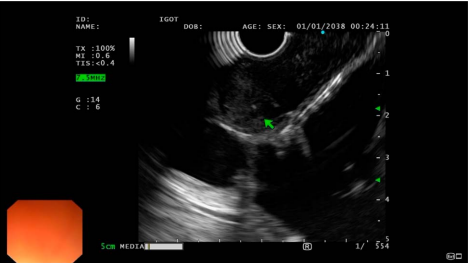 Endoscopic ultrasound showing a well-defined hypoechoic lesion