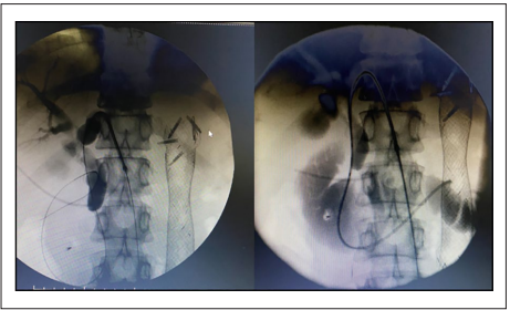 Cholangiogram and biliary stenting through percutaneous approach