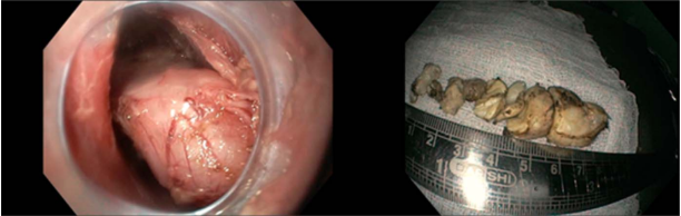 Endoscopic view showing a well-circumscribed smooth submucosal lesion