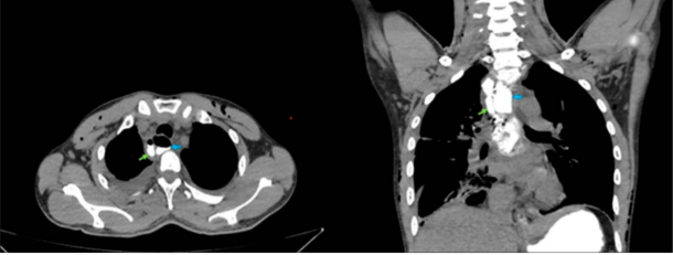 Contrast-enhanced CT thorax showing a small periesophageal collection