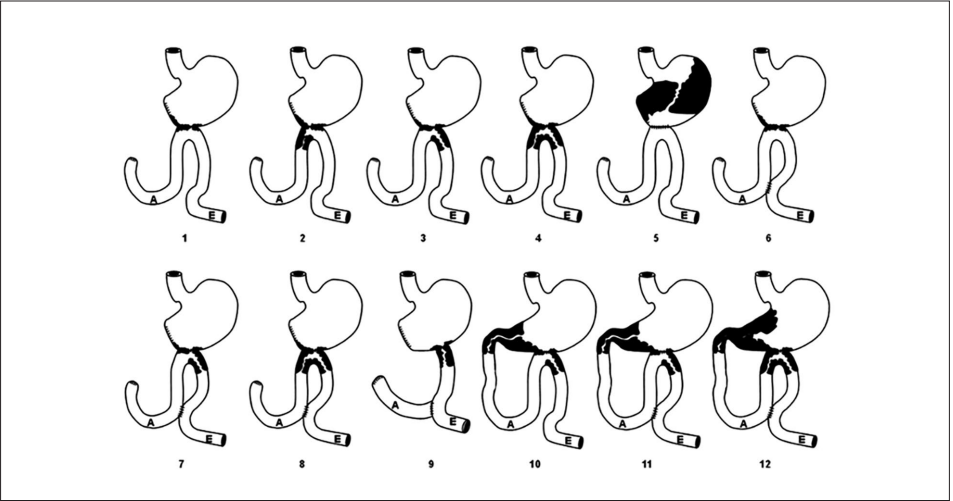 Song classification for types of recurrent malignant obstruction