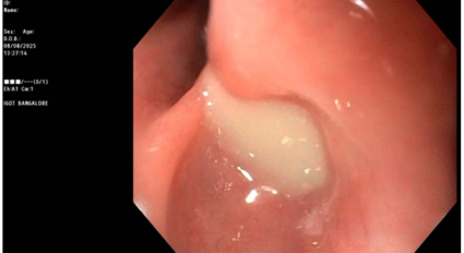 Gastroduodenoscopy showing extrusion of pus into the esophageal lumen