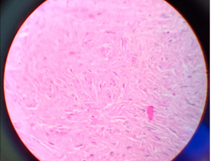 Hematoxylin and eosin stained section consistent with leiomyoma