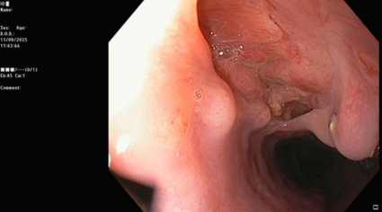 Follow-up upper gastrointestinal endoscopy showing pseudodiverticula