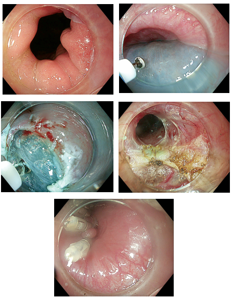 Clinical images showing stages of Peroral Endoscopic Myotomy